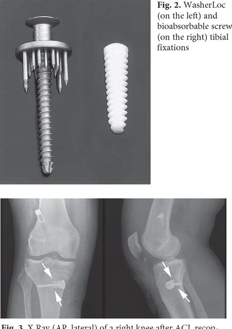 Pdf Comparison Of Bioabsorbable Interference Screws Composed Of Poly