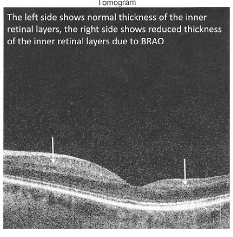 Optical Coherence Tomography Scan Showing Selective Loss Of Inner