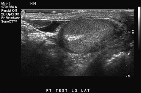 Testis Ultrasound Anatomy