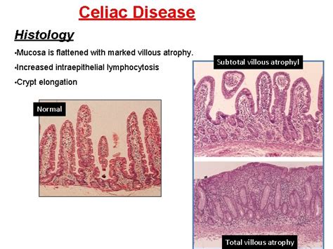 Gastrointestinal Block Pathology Lecture 2013 Malabsorption Dr Maha