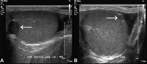 Bilateral Fibrous Pseudotumors Of The Tunica Albuginea In A Pediatric