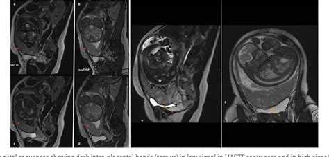 Figure 1 From The Role Of The Radiologist In Diagnosing Placenta Percreta A Case Report And