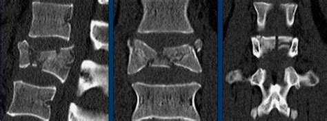 The Radiology Assistant Ao Spine Classification Of Thoracolumbar