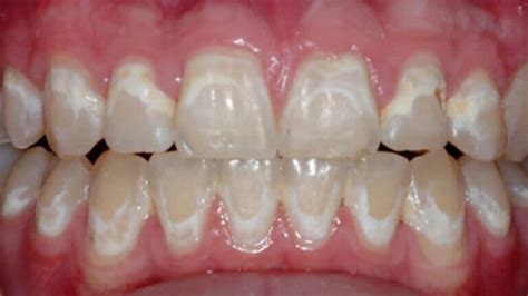 Icon Resin Infiltration Atlas Dental