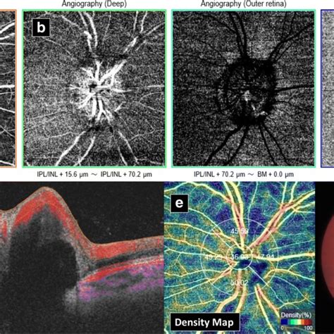 B Scan Mode Optical Coherence Tomography Oct In Optic Disk Drusen Download Scientific Diagram