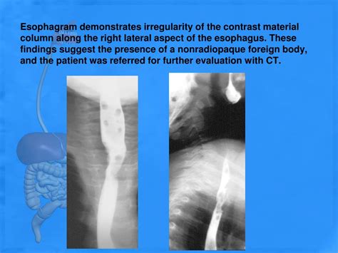 PPT - ESOPHAGRAM PowerPoint Presentation, free download - ID:3086985