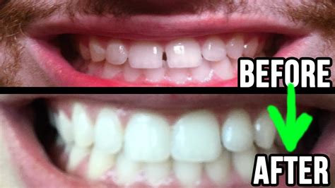 How To Fix Crooked Teeth Without Braces At Home Straighten Teeth