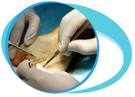 Tendon Repair Surgery In Iran Medpersia Medical Tourism