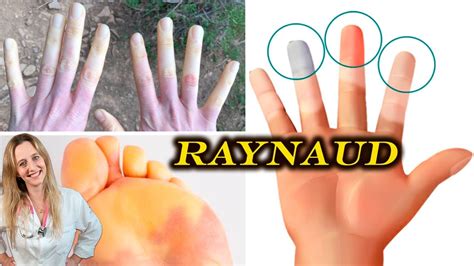 Fen Meno De Raynaud S Ntomas Tipos Diagn Stico Tratamiento Y