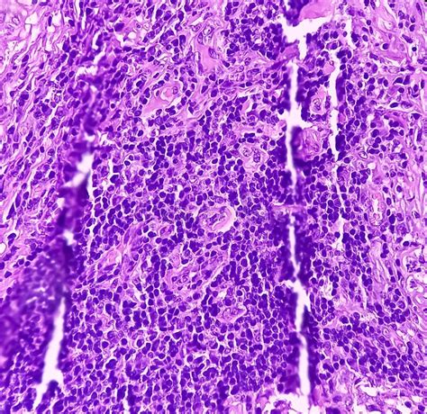 Thyroid Cancer Microscopic Image Of Follicular Neoplasm Malignant