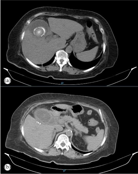 A Axial View Of The Abdominal Ct At Level Of T12 Vertebrae Showing Download Scientific