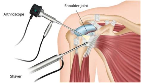 Shoulder Arthroscopy - St. George Surgical Center