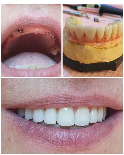 Caz Clinic Reabilitare Dentar Clinica Stomatologic Crinident