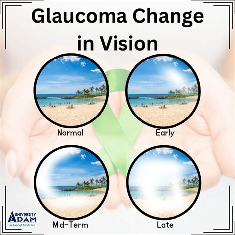 Guide to the Stages of the Glaucoma – School of Medicine