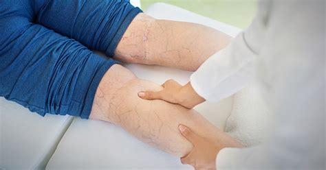 Varicose Veins Remedies And Treatment