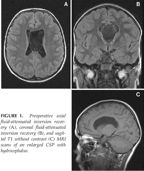 Cavum Septum Pellucidum Diagram