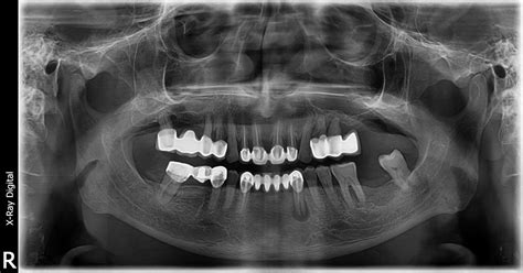 Radiografii Panoramice Digitale Xray Digital