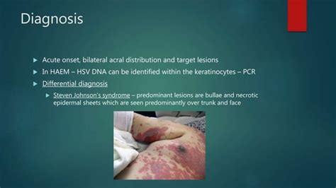 Erythema Multiforme Ppt