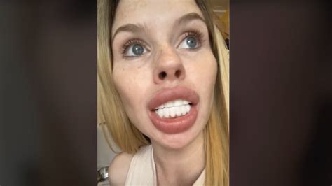 “soy Un Caballo” Se Hizo Un Blanqueamiento Dental Y El Resultado Se Hizo Viral Infobae