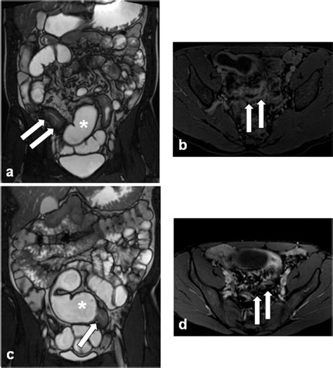 Magnetic Resonance Enterography Images Illustrating An Example Of A