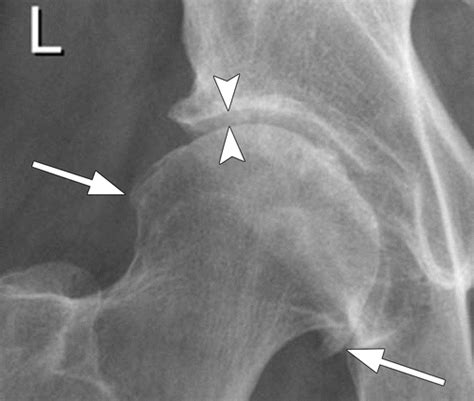 Osteoarthritis Hip X Ray Findings