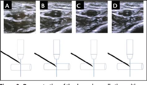 Figure 3 From Summary Of Radial Artery Catheterization And The Factors An Anesthesiologist