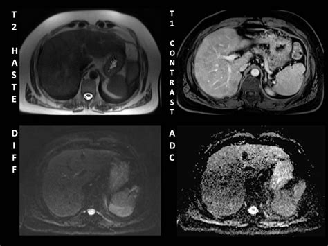 Multifocal Nodular Hepatic Steatosis Pacs