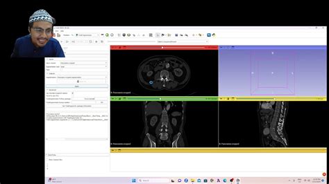 Deep Learning Segmentation 3d Slicer Totalsegmentator Youtube