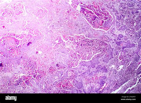 Carcinome épidermoïde histologie Banque de photographies et dimages à