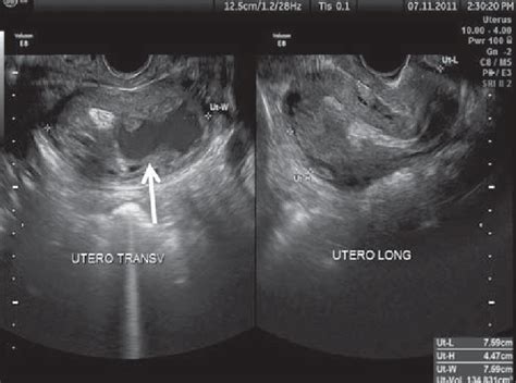 Gray Scale Transvaginal Us Demonstrating Uterus Increased In Volume