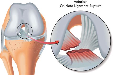 Acl Injury Here Is What You Need To Know Diagnosis And Recovery