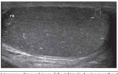 Table From Prevalence Of Testicular Microlithiasis In Males Aged To