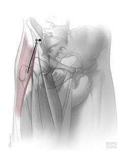 anterior approach hip replacement — Gormack Orthopaedics