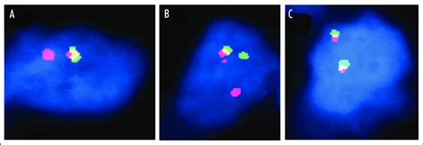 FISH Images Of TMPRSS2 ERG Fusion Assay A FISH Image Of