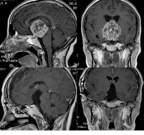 Craniopharyngioma And Pituitary Adenoma