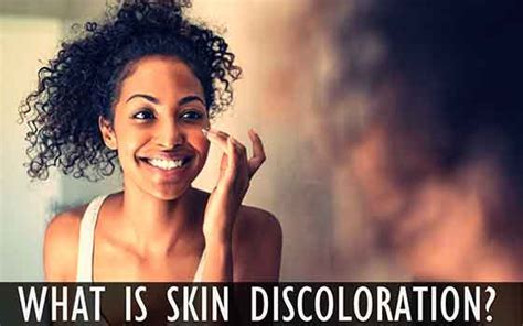 Skin Discoloration – Types, Causes, Treatment, & Much More - Health