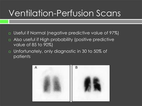 Ppt Pulmonary Embolism Presentation To Diagnosis Powerpoint