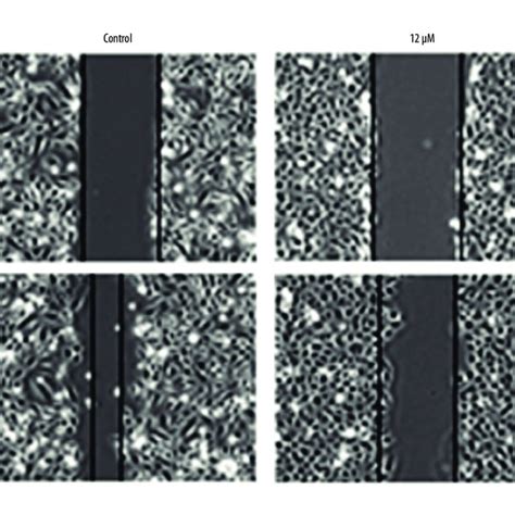 Cell Migration In Mda Mb 231 Human Breast Cancer Cells Is Inhibited By