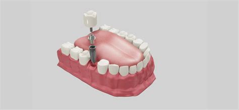 Implantes dentales la mejor solución para tu boca Clínica Sanura