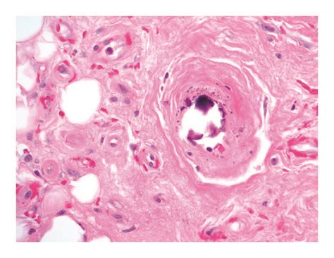 Photomicrograph From Left Leg Skin Punch Biopsy Showing Calcification