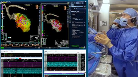 Advisor HD Grid Mapping Catheter SE Education And Training Videos Abbott