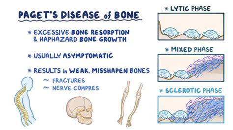 MSK Paget S Disease Osteomalacia Bone Tumours Flashcards Quizlet