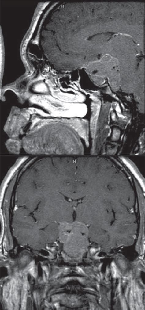 Sagittal A And Coronal B Post Gadolinium Mri Showing A Large Sellar