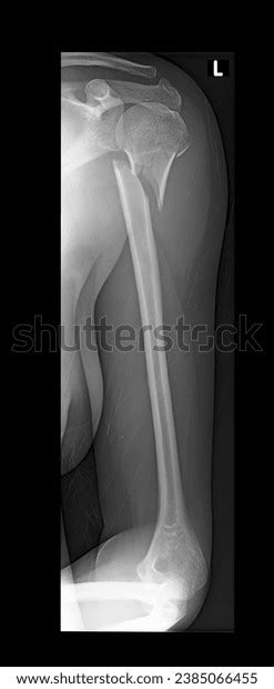 29 Surgical Neck Humerus Images, Stock Photos, 3D objects, & Vectors | Shutterstock