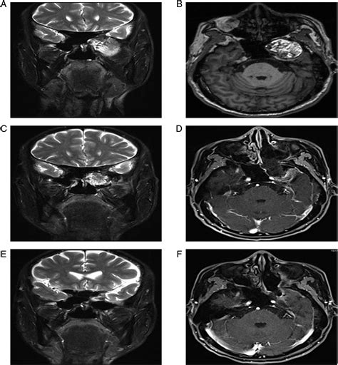 Endoscopic Endonasal Surgery For Dermoid Cysts Arising From The Middle