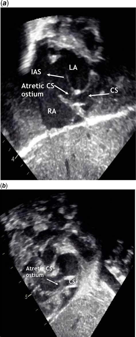 Coronary Sinus Ostial Atresia With Persistent Left Superior Vena Cava