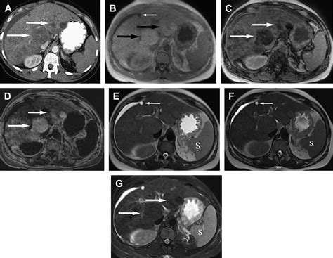 Mr Characterization Of Focal Liver Lesions Magnetic Resonance Imaging