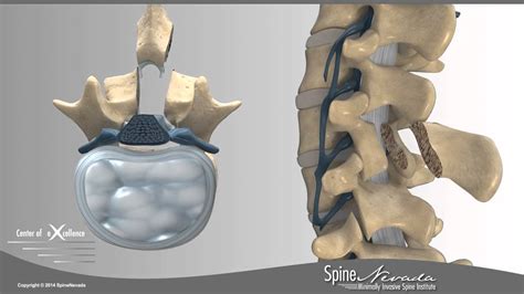 Lumbar Laminectomy In Reno At Swift Institute Northern Nevada Center