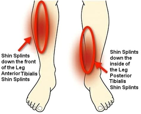 Shin Splints Wat Is Het En Hoe Voorkomen Genezen Leonto