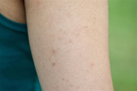 Keratosis Pilaris: How To Get Rid of Chicken Skin | The Healthy